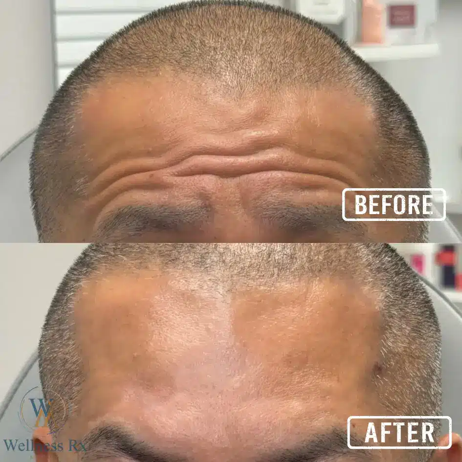 Side-by-side before-and-after photos of a man's hairline showing increased hair density after treatment.