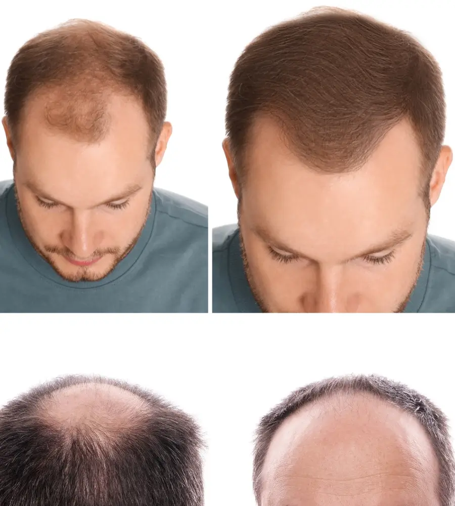 Collage showing a man with thinning hair on top and bald patches from multiple angles.